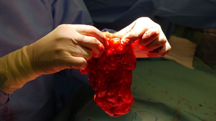 Surgeon holding up bodily tissue during surgery 