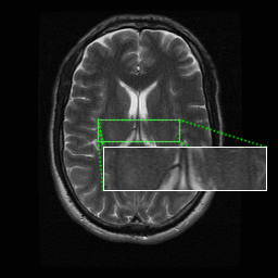 Segmentation of MRI slice