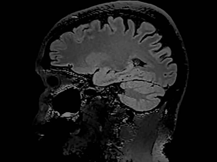 An image of a brain scan